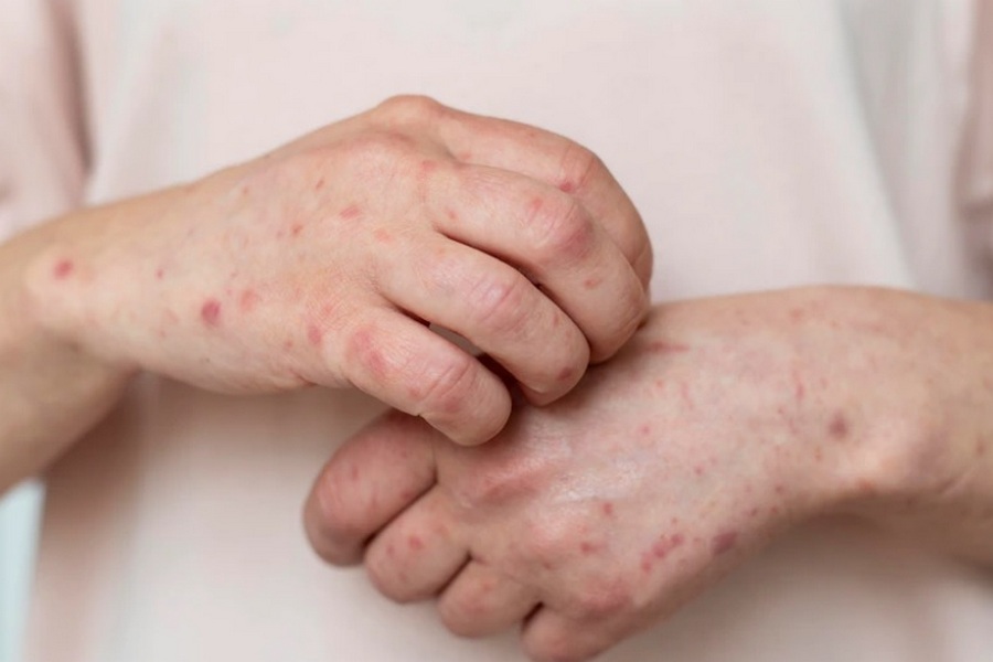 Заразность - сто процентов: по Казани летает корь