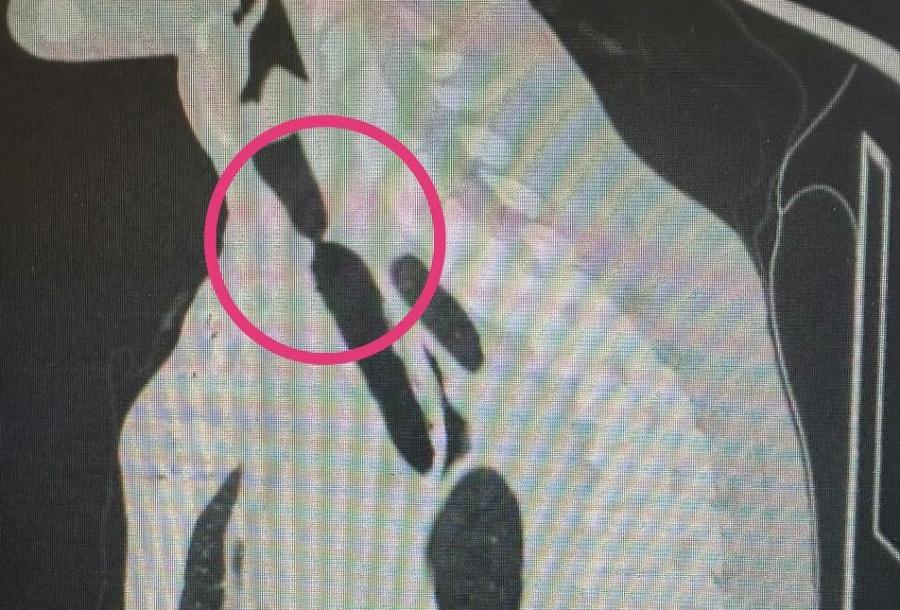 Врачи в Казани расширили трахею мужчине, попавшему в ДТП 10 лет назад