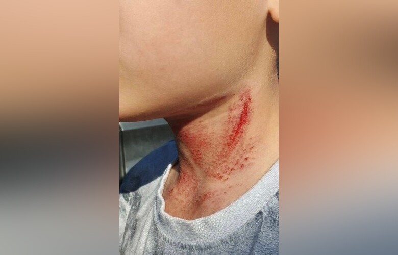 В Татарстане завели дело после того, как мальчик порезал шею тросом на дороге