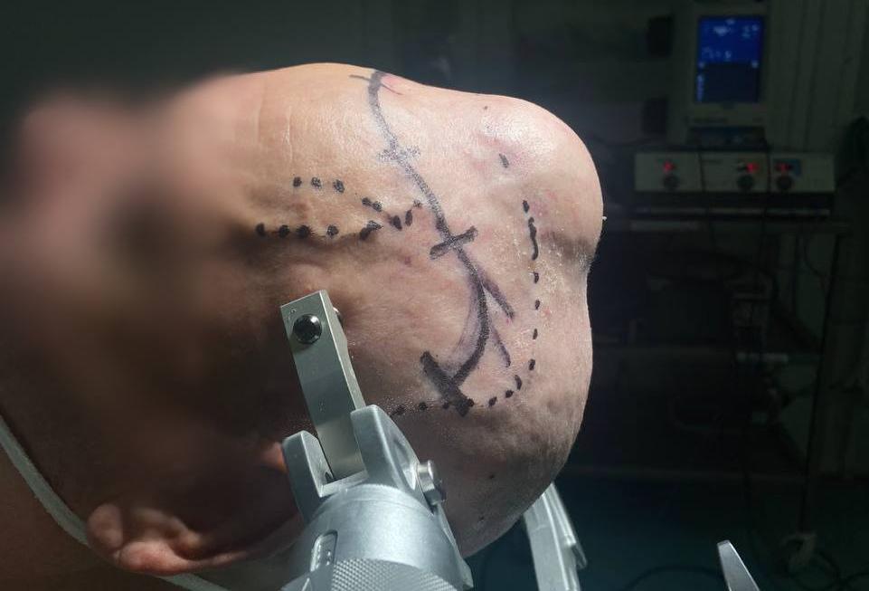 Выросший на голове метастаз от рака почки удалили у жителя Татарстана