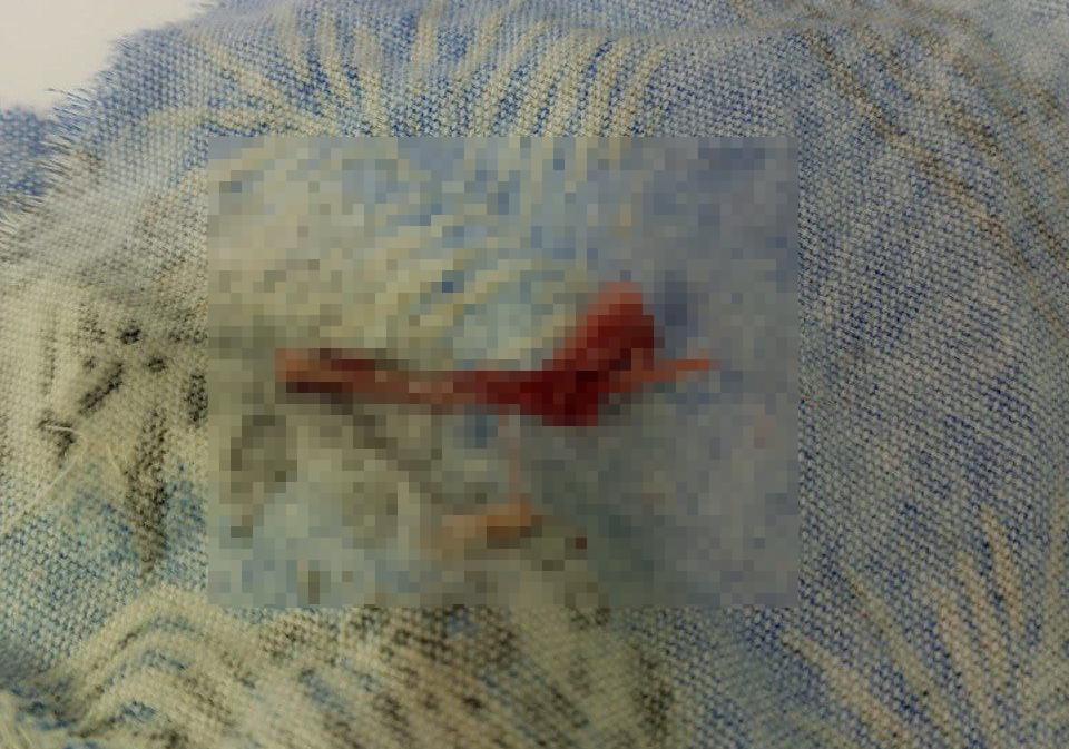 В Татарстане врачи спасли мужчину, едва не погибшего из-за кости в гортани