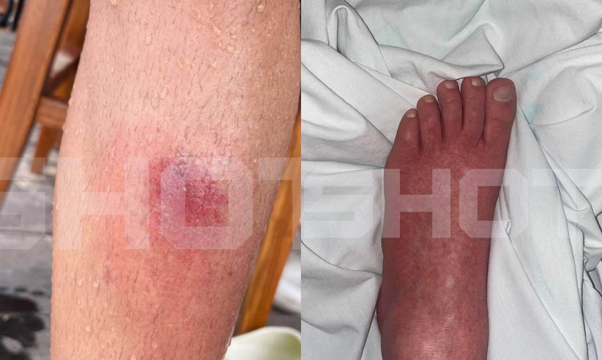 Десятки россиян на Бали заразились смертельной лихорадкой денге