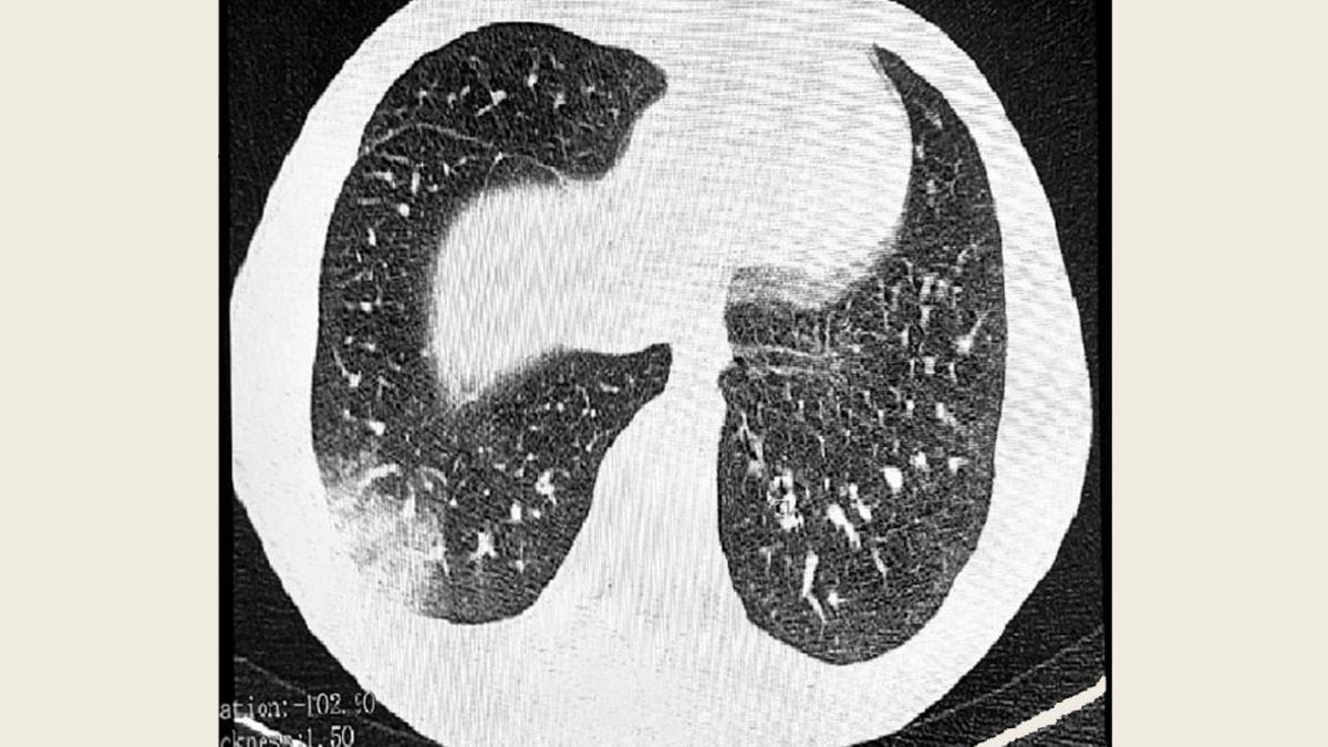 Один из первых случаев «попкорновой болезни» вейперов выявили в России
