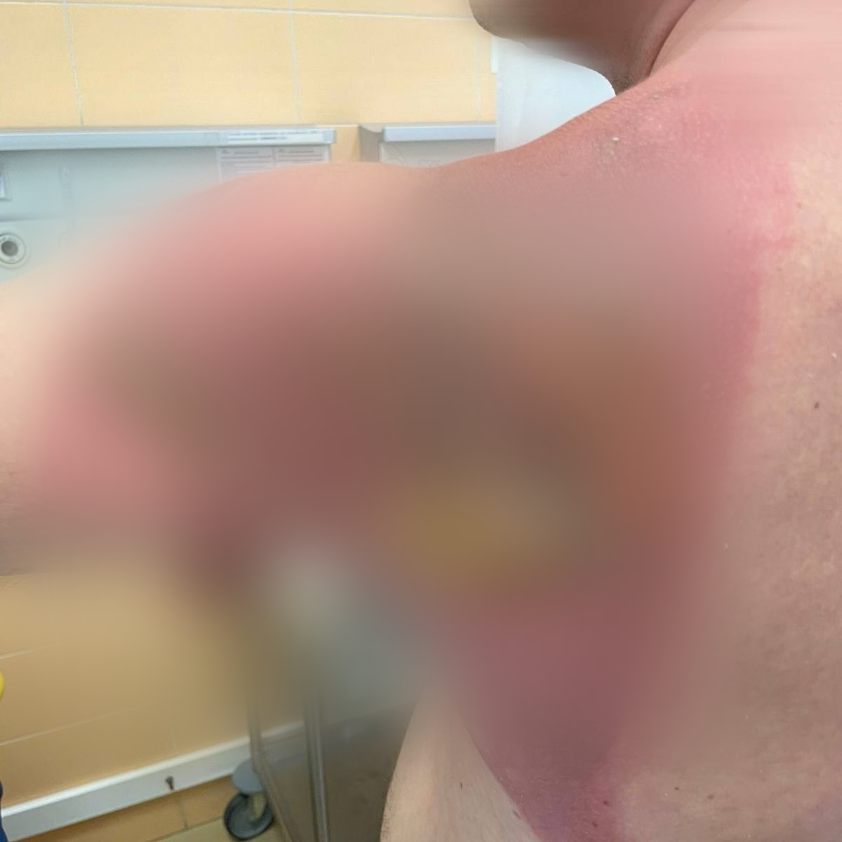 Мужчина из Казани получил химический ожог от постиранного капсулами белья