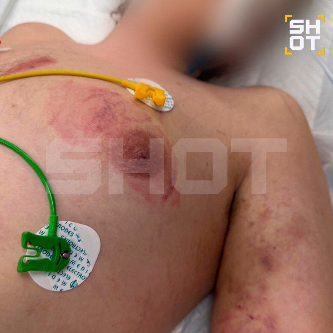 У подростка, которого жестко избивали в подмосковном рехабе, начался сепсис