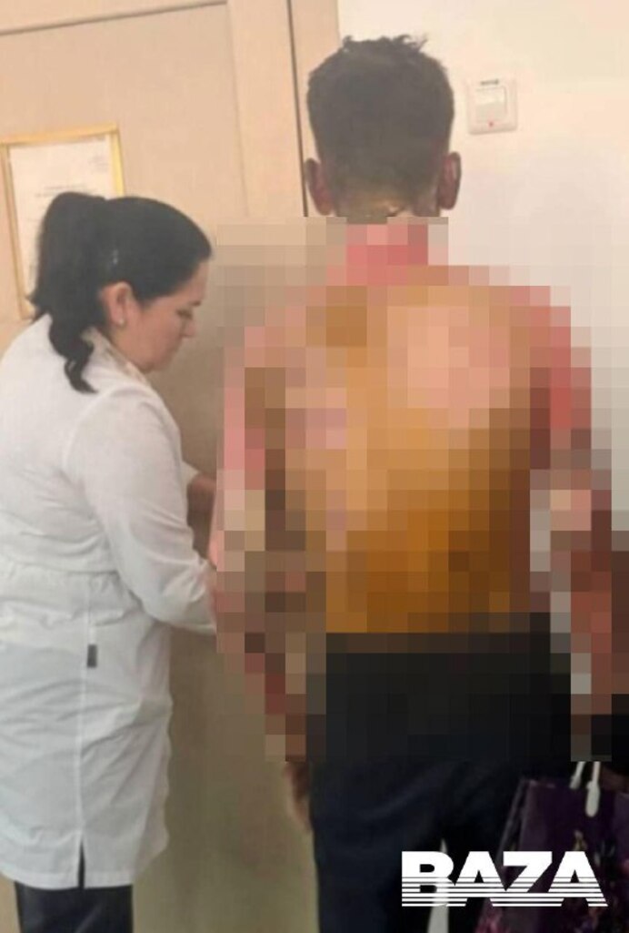 Пересадка кожи нужна школьнику, которого подожгла одноклассница в Красноярске