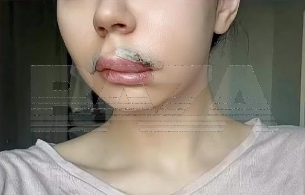 Жительница Казани чуть не лишилась губы после филлеров и пластики