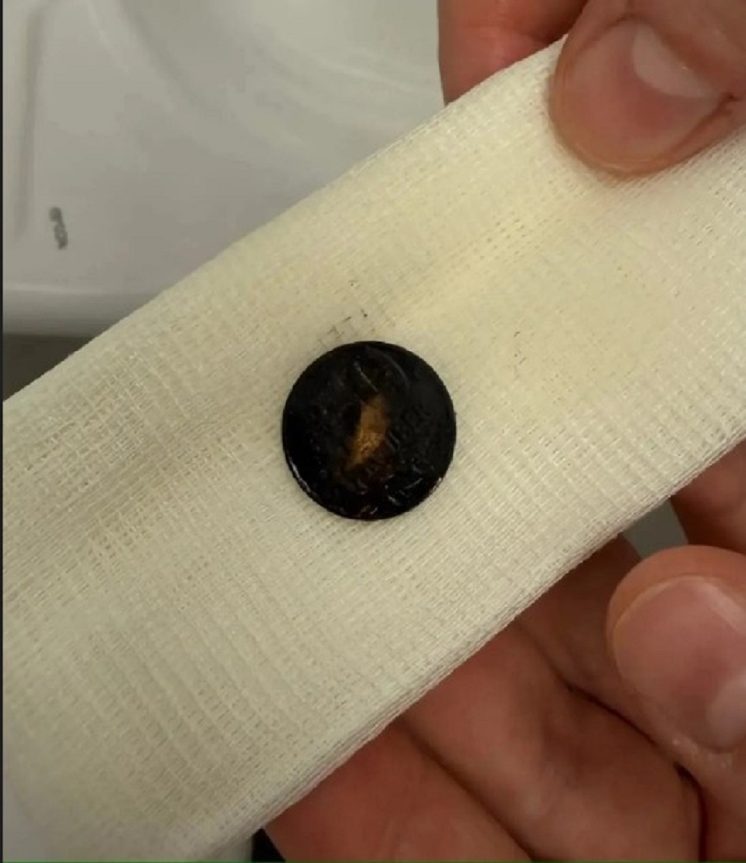 Альметьевский детский хирург спас проглотившего монету ребёнка