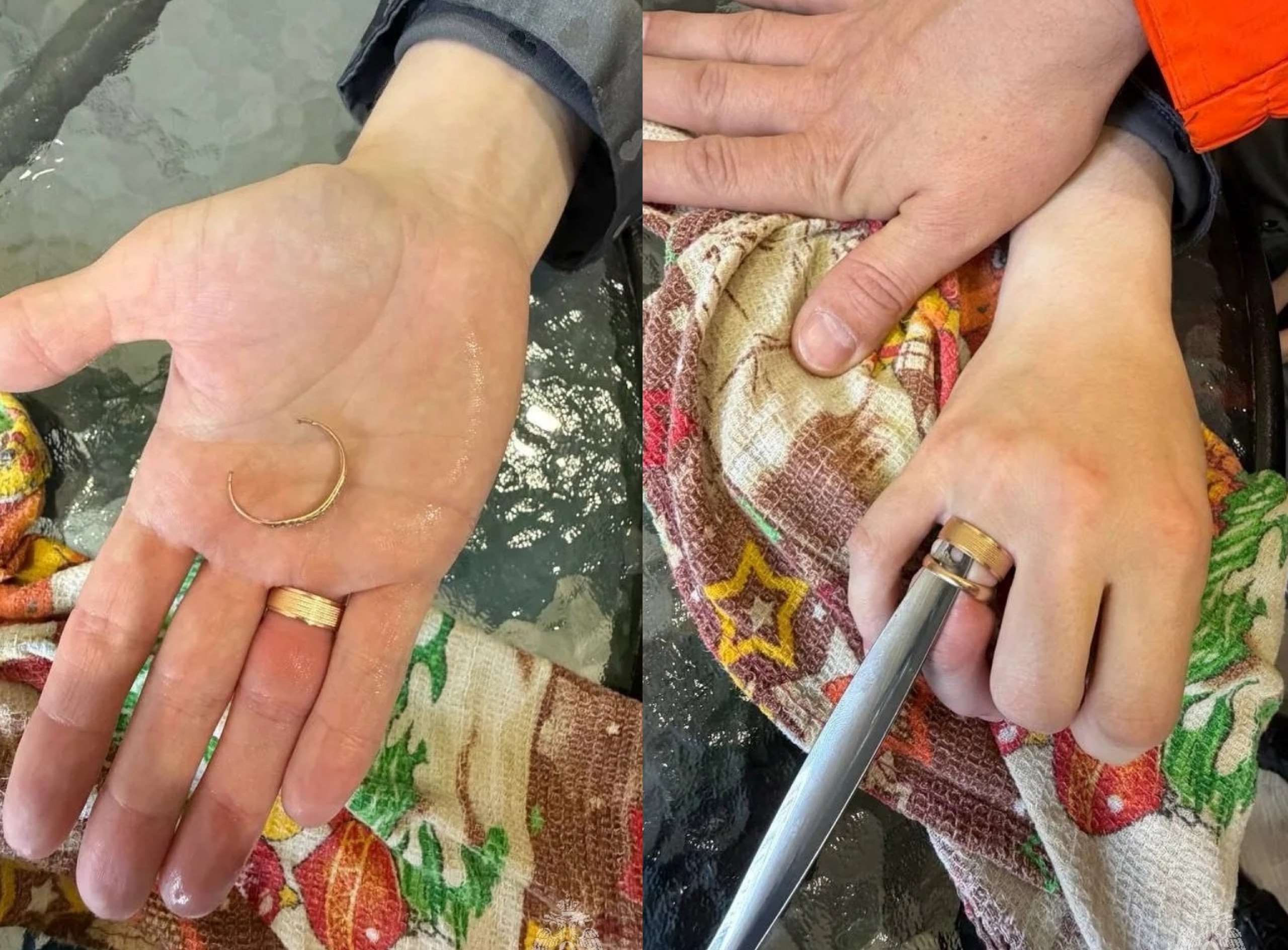 Казанские спасатели помогли женщине с младенцем снять обручальное кольцо